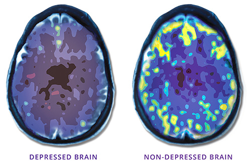 Depressed Vs. Non-depressed brain scan
