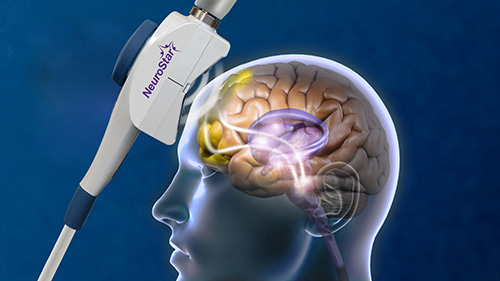 Neurostar TMS treatment head scan